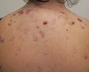 Quello che è fatto dal cosmetologo con unacne